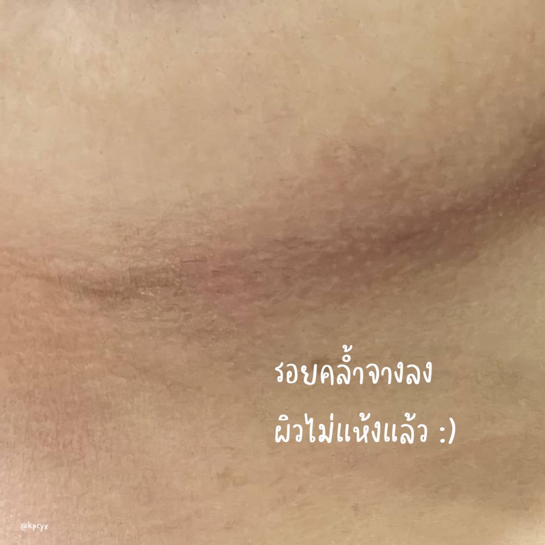 kpcyx's tweet photo. มารีวิวอาการที่ไม่น่าจะเป็น แต่เป็นเฉยเลย555 เราเป็น “ผื่นแพ้ชุดชั้นใน” ผิวใต้ราวนมแห้งจนเป็นขุย ลอกตกสะเก็ดเลยอะ เครียดมากๆ เลยลองใช้โลชั่นยูเรียของ eucerin ที่หมอผิวหนังแนะนำ แก 7 วัน ผิวกลับมาเป็นเหมือนเดิม y_y รอยคล้ำก็จางลงด้วย ดีใจจนจะร้องไห้ 😭🤟 
#ใช้ดีบอกต่อ https://t.co/t8I6aQ7CV2