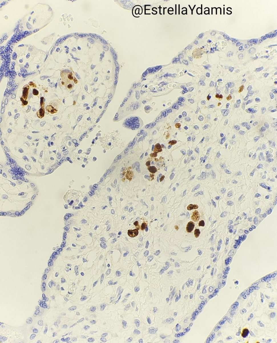 Cytomegalovirus (CMV) in placental villi; CMV is one of the most common in utero viral infections in the USA; intrauterine growth restriction is the most common result #pathology #perinatal #placenta #pedipath