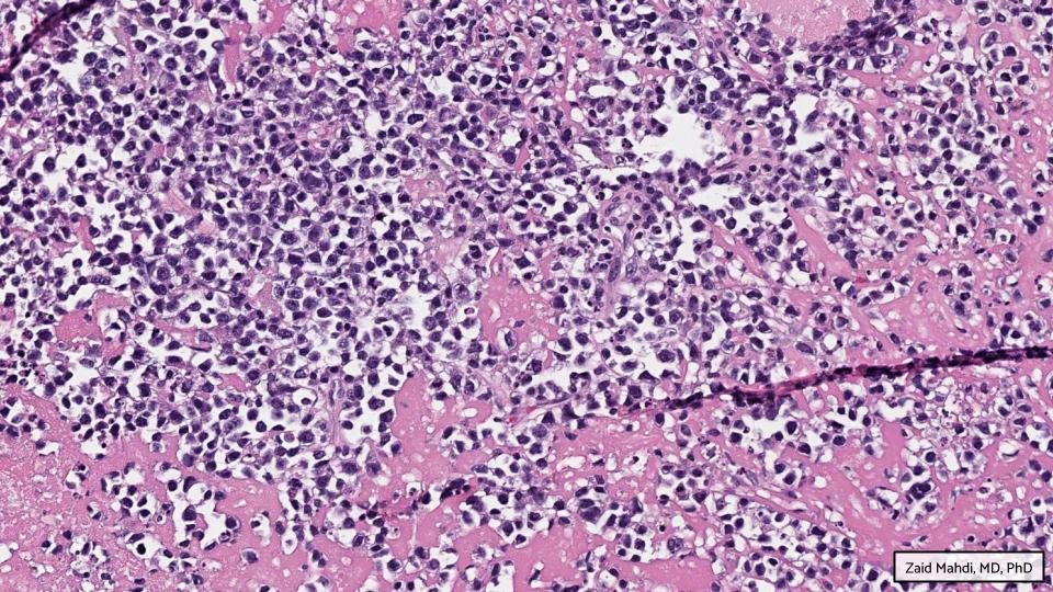GAP Case of the Month #10:

73♂️ w/ PMH of colonic adenocarcinoma, 8 cm subhepatic cystic lesion identified on imaging &amp; resected.

By: Zaid Mahdi, MD, PhD

📸  WSI: bit.ly/3Km6svl
💡 Answer: bit.ly/3Lzd1fm

#GAPCoTM #gipath #liverpath #hemepath