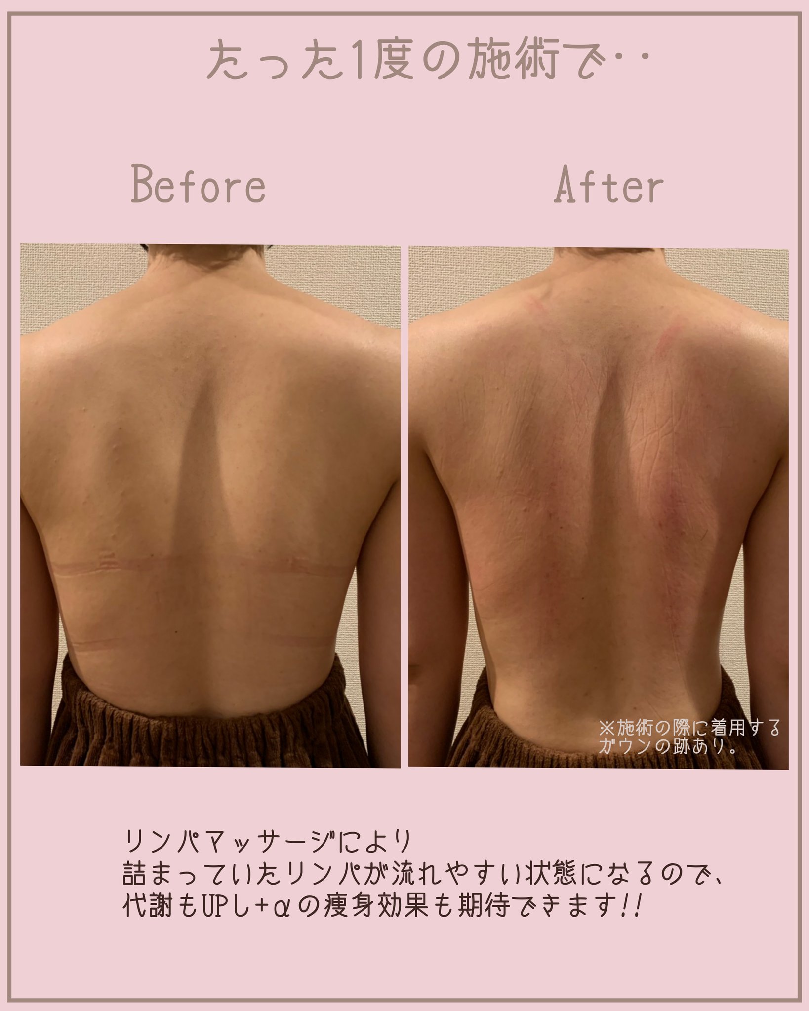 公式 育乳マッサージ専門店 P Grandi ピーグランディ 肩甲骨周りが凝り固まっている女性はとても多く これではバストに栄養が行き渡りにくい状態になっています まずは詰まっているリンパを流しバストアップしやすい土台を作っていくことが重要です