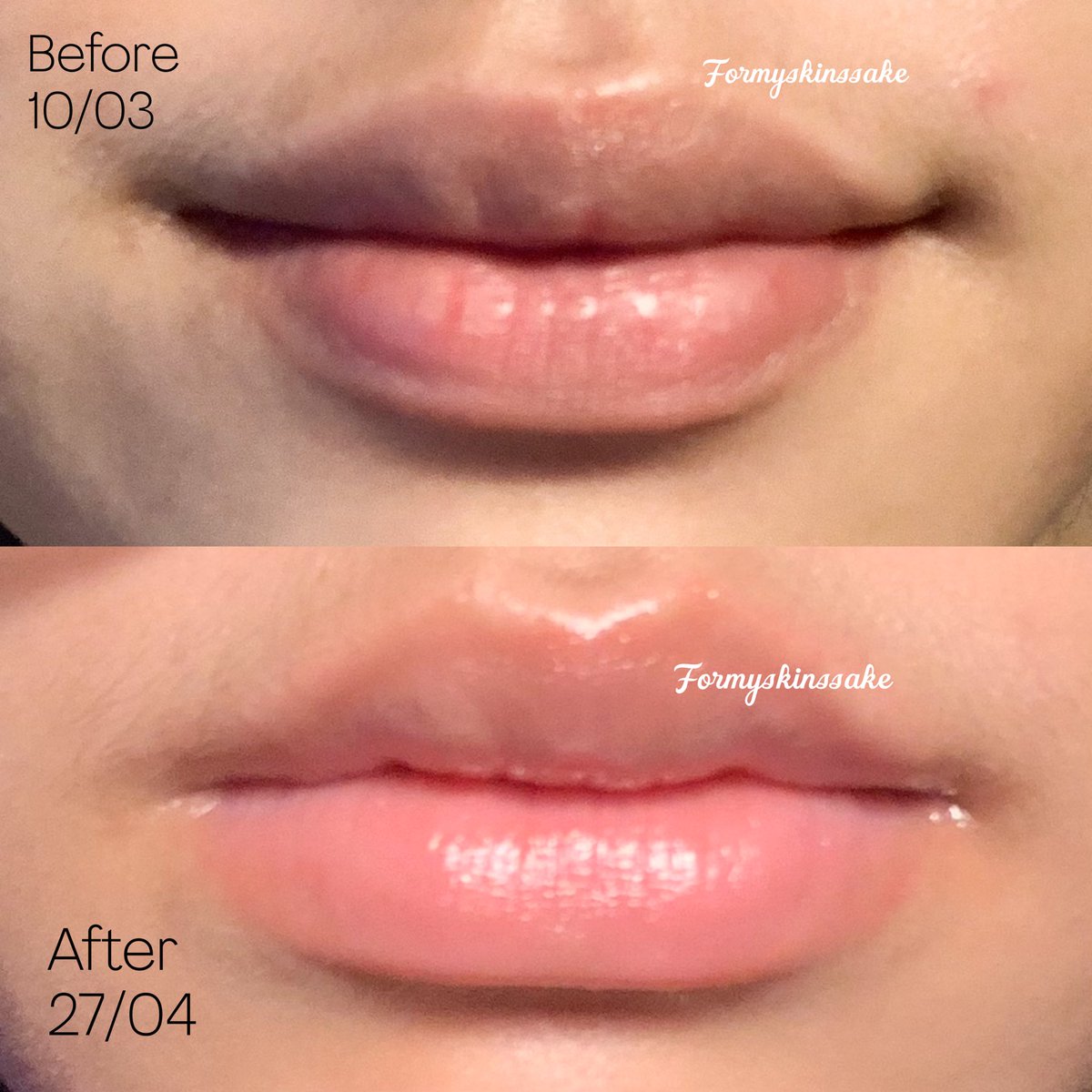 fitaminci's tweet photo. —MY LIP CARE—
<A thread> 

sebuah usaha buat ngurangin pigmentasi bibir karena kebiasaan konsumsi kafein, dan setelah hampir 2 bulan akhirnya membaik  

ya itung itung juga coba cobi lipcare yg lg ngetrend https://t.co/wrKsNq3TXL