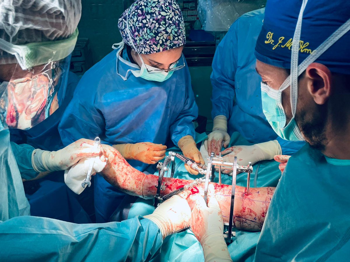 HospitalJaen's tweet image. 🔷El @HospitalJaen incorpora las últimas técnicas disponibles en fractura de tibia🦴

⚙️La aplicación de osteosíntesis definitiva de tibia con fijador externo circular beneficia a un joven que sufrió una fractura compleja

ℹ️ + info, aquí 🌐hospitaljaen.es/el-hospital-de…

#HUJsemueve