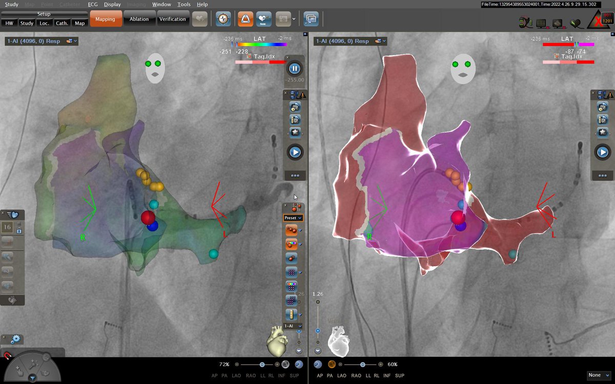 Laila_G's tweet photo. Right posteroseptal WPW Open window UNIVU CARTO 3 mapping #EPeeps @JosMart42952309 @cardiologiaCHUS https://t.co/MyfIPcecJs
