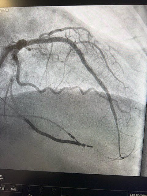 KeithNguyenSAIF's tweet photo. Cto Antegrade with laser atherectomy to the LAD. @SAIFSanAntonio https://t.co/fgIrrUkpoq