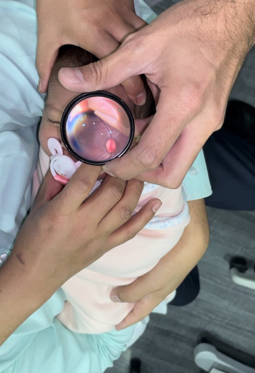 jjimenez85's tweet image. Con 6 manos, un iPhone y un lente de 20D podemos hacer tamiz visual y valorar a recién nacido. Igual tenemos las herramientas para tomar la presión con icare.