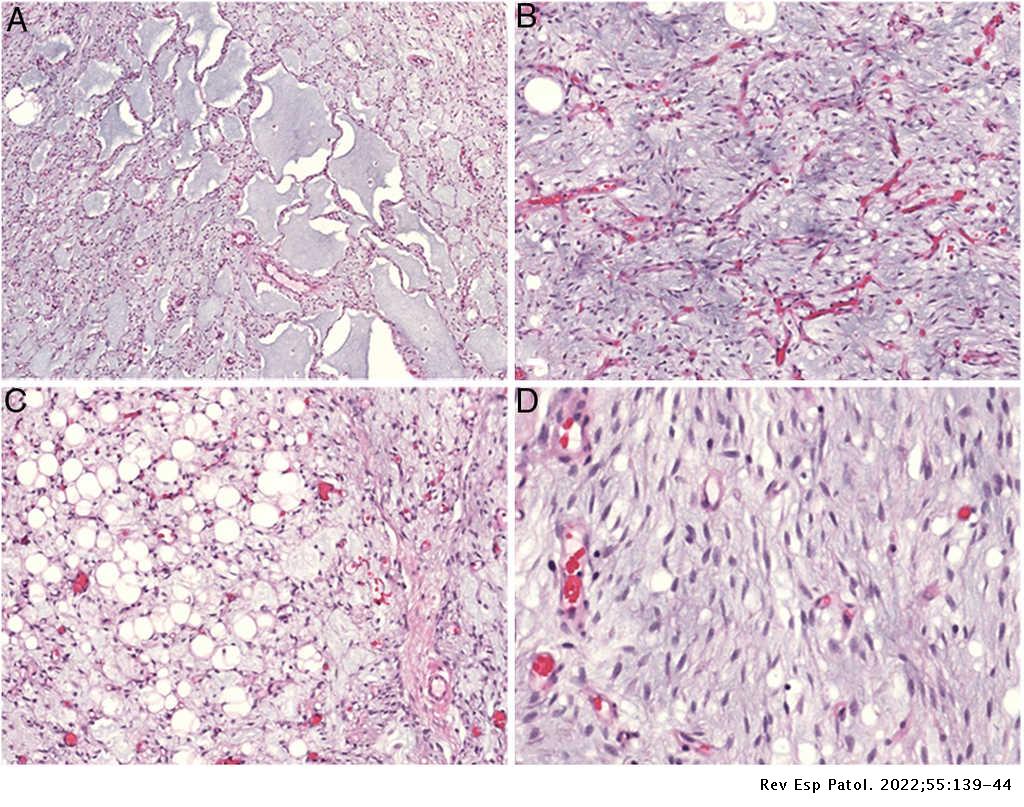 REP_Patologia's tweet photo. Vol 55 (2). Vásquez-Dongo C et al. Lipoblastoma-like tumor of the vulva: A case report and review of the literature. https://t.co/iEdUkH9eMh https://t.co/TernIFYMNj
