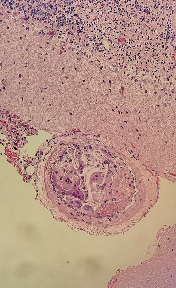 mawgdn's tweet photo. Posterior fossa AVM. Some of the small arteries outside of the malformation contained nonpolarizable foreign material, consistent with hydrophilic polymer embolus.#neuropath #microemboli https://t.co/ldkXNrYGZP