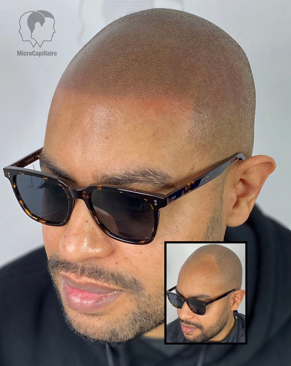 microcapillaire's tweet photo. No more baldness #scalpmicropigmentation 

💻https://t.co/9AfpB4Rf3C https://t.co/fZtxeMf4R6