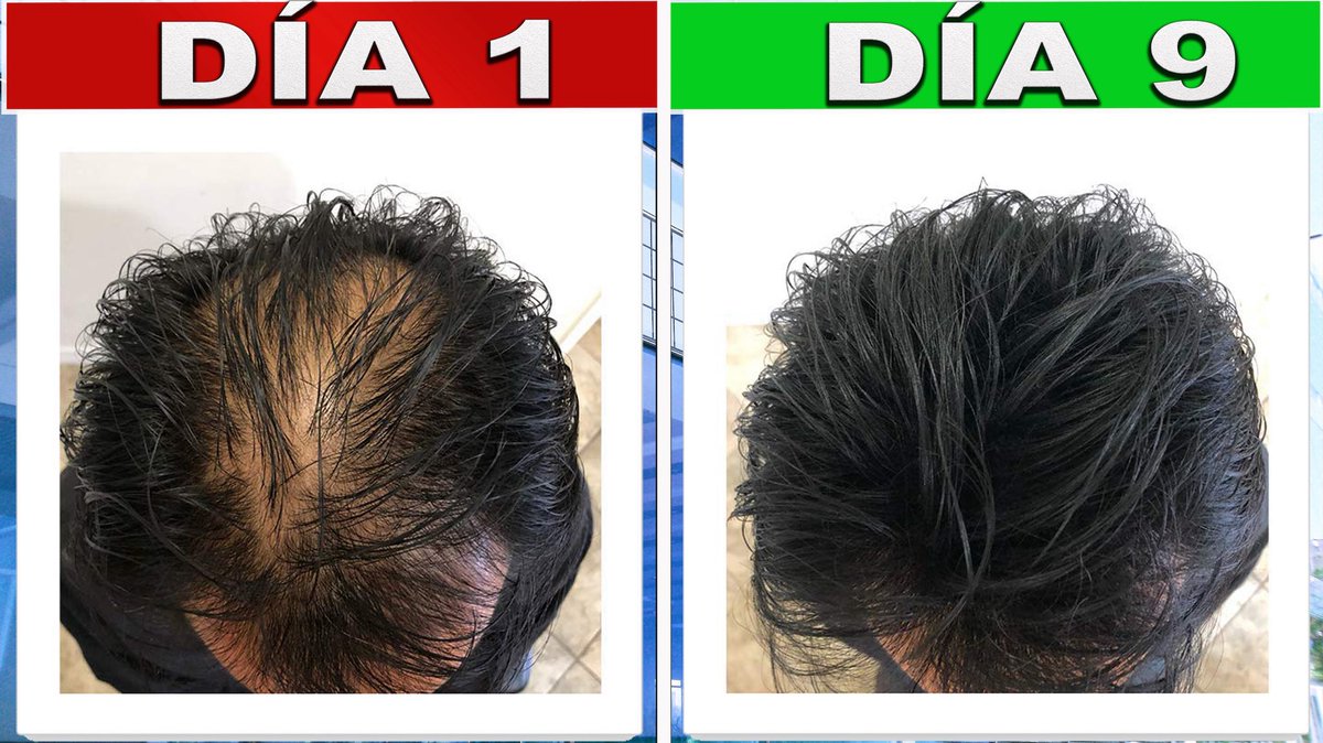 jorgemisaglez's tweet photo. 🔺Trucos Efectivos Para Tener Cabello Sano, Grueso Y Abundante
https://t.co/d08ucJhMN4 https://t.co/IOqQHmQ9TB