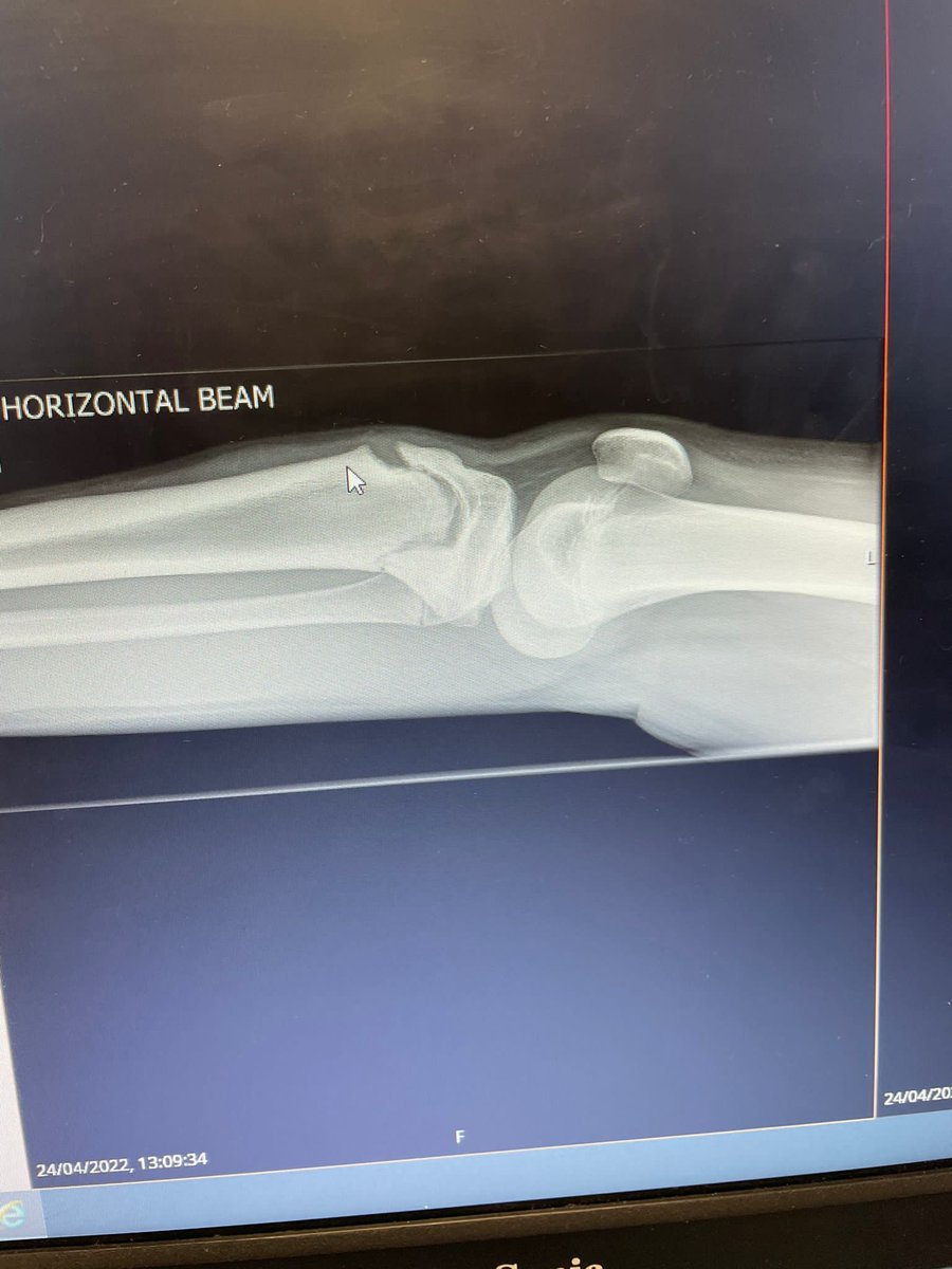 AndyBrett82's tweet photo. @WWLNHS huge thanks for looking after Fraser after his football injury on Sunday. Surgery went well and your wonderful team made him feel very comfortable and made the traumatic exoerience for me and his mum(s) much more manageable 🤣 #OnTheMend https://t.co/WNOiP4SZIL