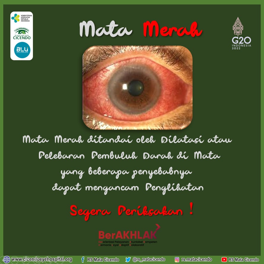 rs_matacicendo's tweet image. “mata merah ditandai oleh dilatasi atau pelebaran pembuluh darah di mata, yang beberapa penyebabnya dapat mengancam penglihatan” #SalamSehattMata #edukasi #pkrs #matamerah #rsmatacicendo