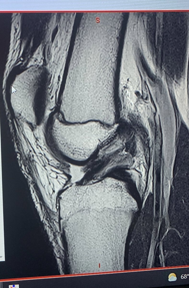 I’ll be back💪❤️🏈⚽️ 2nd degree MCL sprain and Torn ACL. The road to recovery will be difficult but I have the people and attitude that is needed.