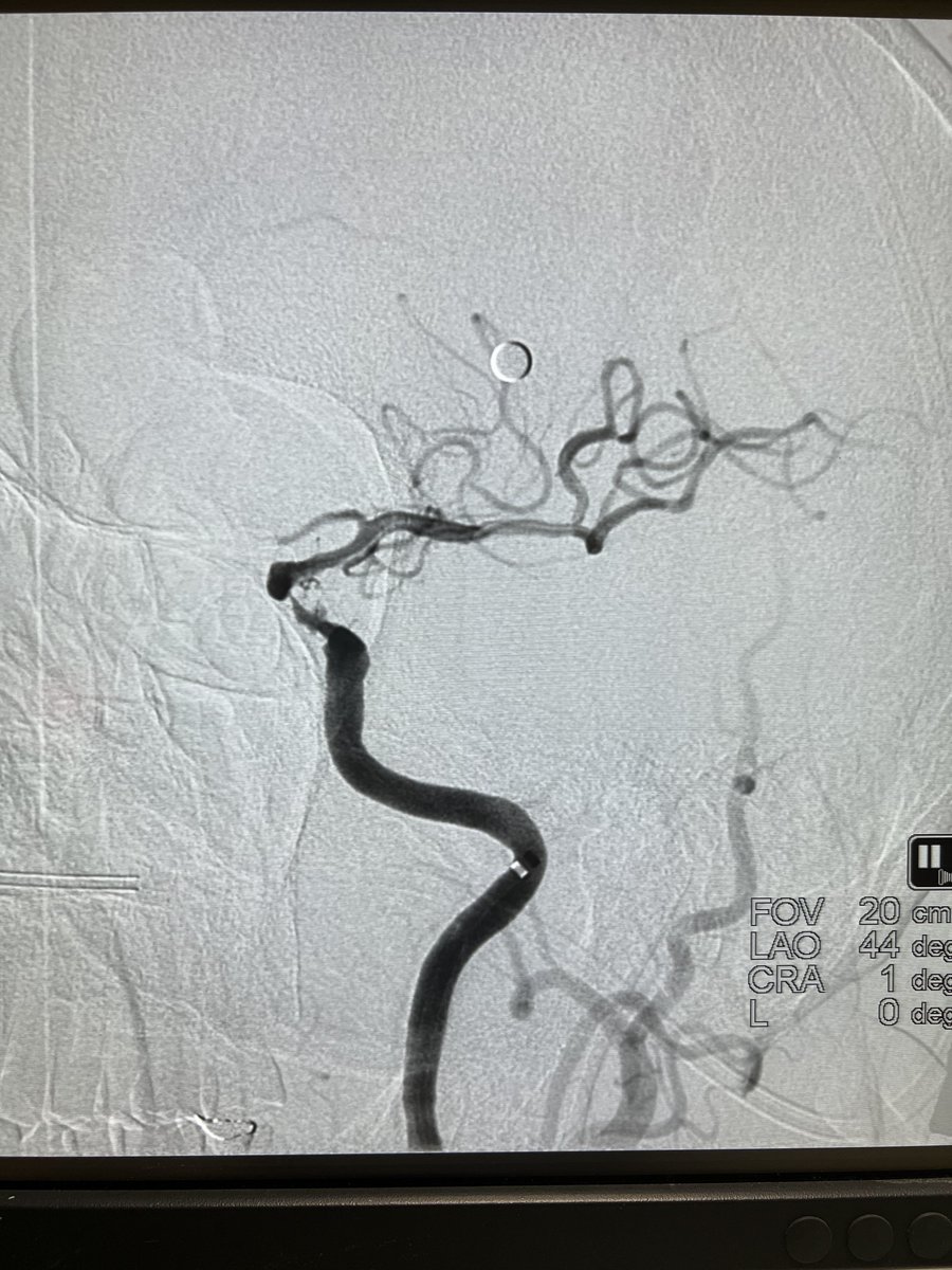 #RadialFirst 
#RadialforNeuro 
what’s your setup?