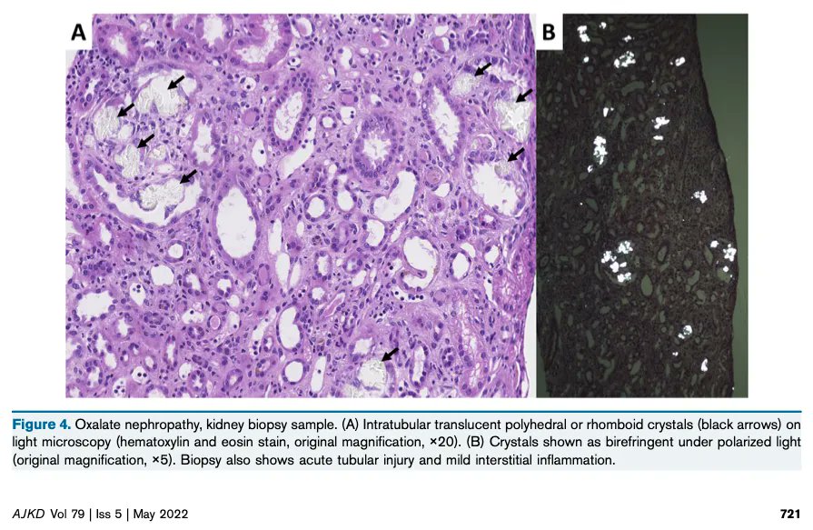 AJKD (@ajkdonline) on Twitter photo Pathophysiology and Management of Hyperoxaluria and Oxalate Nephropathy: A Review
buff.ly/3xZ7dYH (FREE)
<a href="/DemoulinNathal2/">Demoulin Nathalie</a> <a href="/JohannMorelle/">Johann Morelle</a> Pathophysiology and Management of Hyperoxaluria and Oxalate Nephropathy: A Review
buff.ly/3xZ7dYH (FREE)
<a href="/DemoulinNathal2/">Demoulin Nathalie</a> <a href="/JohannMorelle/">Johann Morelle</a>