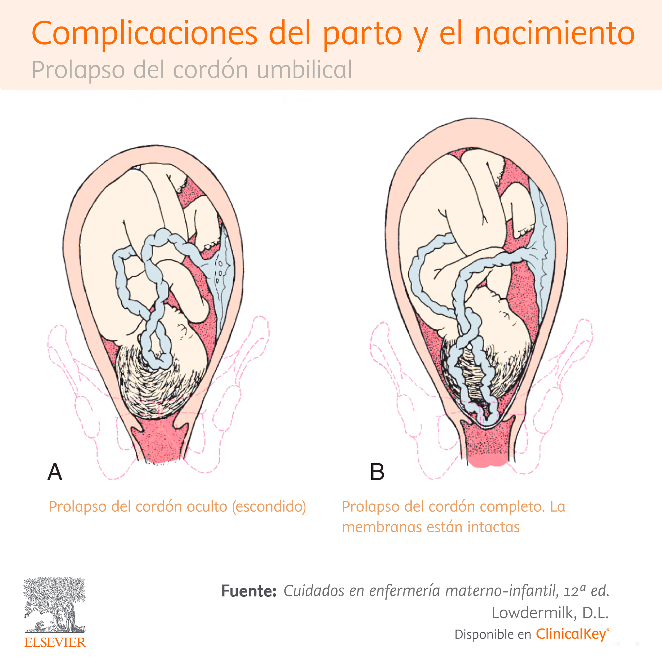 Limitado Perímetro ordenar prolapso de cordon umbilical cuidados de