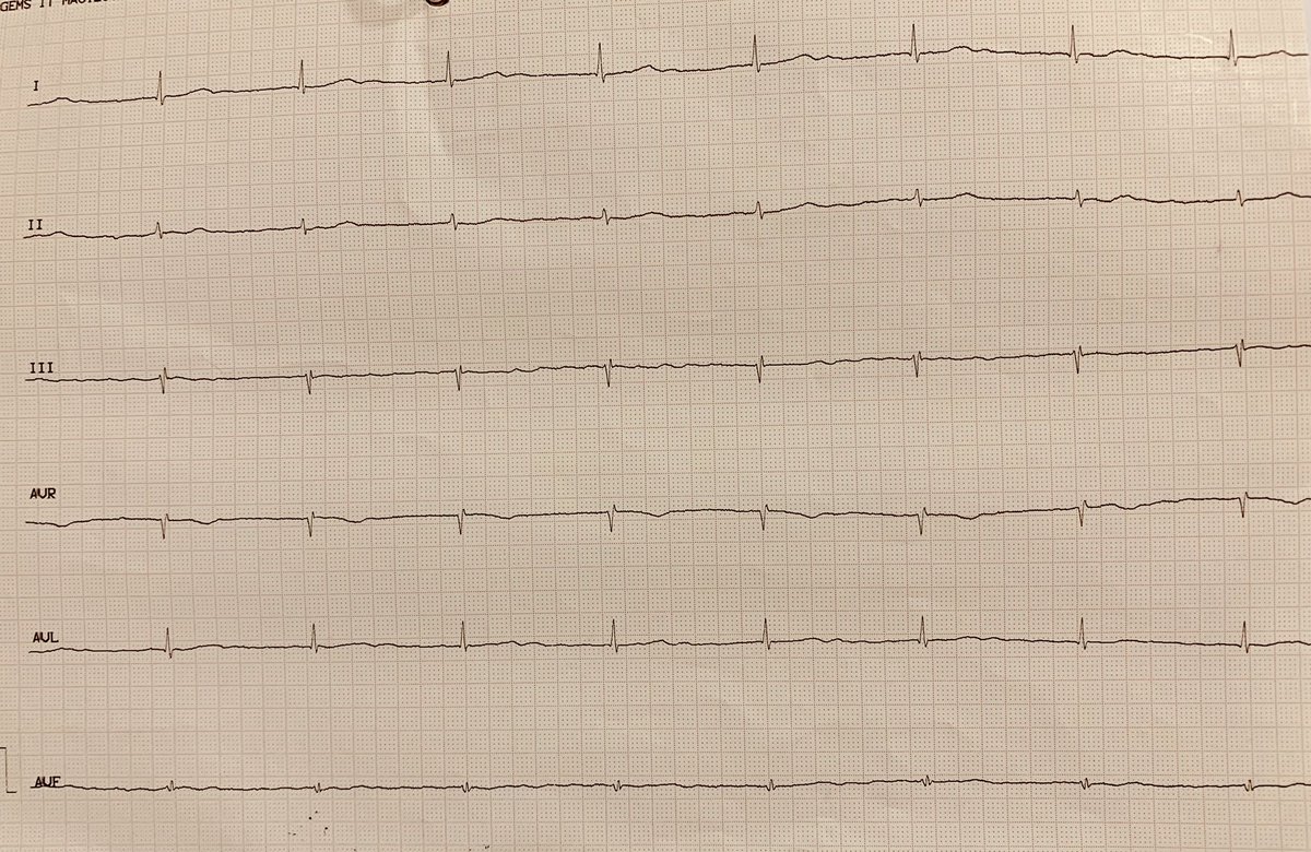 IsaParam's tweet photo. Que les parece este #ECG ?
#CardioTwitter https://t.co/IpKKUyXaBB
