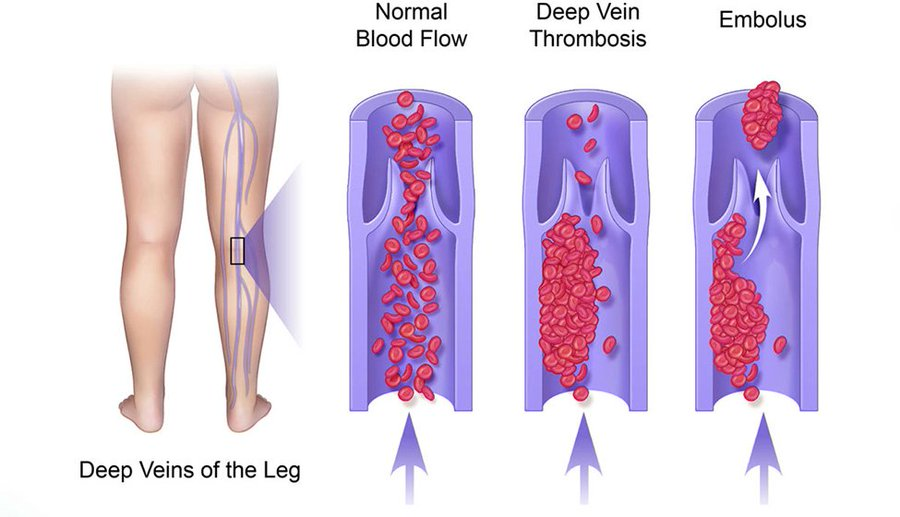 2002Mertcelik's tweet photo. 1. What is DVT
Deep Vein Thrombosis occurs when a blood clot (thrombus) forms in 1 or more of the deep veins in the leg. The most common sight of this are the Anterior tibial vein, Posterior Tibial Vein, Peroneal Vein, and Popliteal Vein. https://t.co/GUplvcl9aD