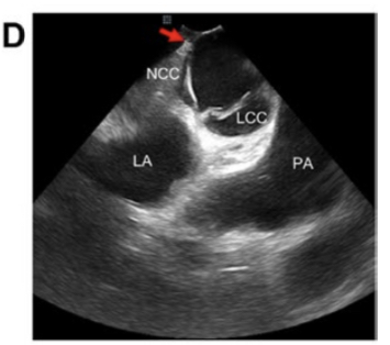 🚨The RV showes early activation at the His region (−40 ms), with excellent pace mapping. Would you start ablation or pass NCC? Great case presentation by <a href="/AndreasMetzner7/">Andreas Metzner</a> <a href="/BURAKCMD2/">Cengiz Burak, MD, DRCPSC</a> and <a href="/AKorogyi/">Adam Korogyi</a> in #JICE ⬇️⬇️⬇️
#EPeeps #CardioTwitter
link.springer.com/article/10.100…