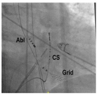 JICE_EP's tweet photo. 🚨The RV showes early activation at the His region (−40 ms), with excellent pace mapping. Would you start ablation or pass NCC? Great case presentation by @AndreasMetzner7 @BURAKCMD2 and @AKorogyi in #JICE ⬇️⬇️⬇️
#EPeeps #CardioTwitter
https://t.co/U6RNLtLYhT https://t.co/IXoo2g3DtY