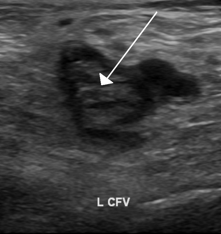 2002Mertcelik's tweet photo. 4. Investigation of DVT
- Ultrasound Scan
- D- dimer blood test
- MR/CT venography
- Compression Ultrasound https://t.co/hknbNrdwUF