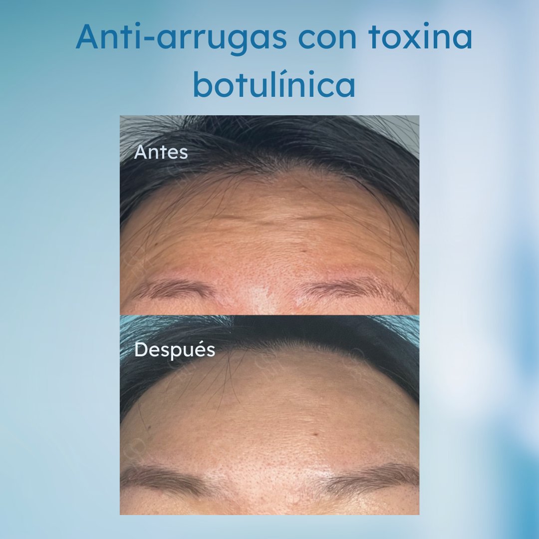 GoBIT_clinic's tweet photo. Si eres joven y tienes mucha expresión facial, el bótox es preventivo para las arrugas en la frente, entrecejo y patas de gallo. Buscamos un efecto natural permitiendo ligeros movimientos de las cejas, así sigues expresándote sin miedo de formar más arrugas estáticas.
#GoBIT https://t.co/D61KPkIeuT