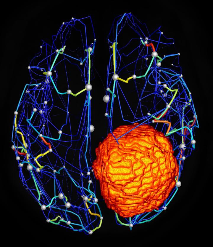 CourtiolJulie's tweet photo. #BrainTumorAwarenessMonth

Only 50%-70% of patients with #glioblastoma can access #surgery

Discover #TheVirtualBrain #Tumor #Patient and its #dataset on the #EBRAINS knowledge graph showcasing the importance of personalized #medicine
 
https://t.co/aGkgDBvVZJ

@BTNcares #GrayMay https://t.co/JJIkqo64uG
