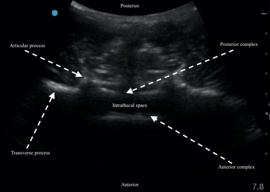 BJAJournals's tweet image. USS before central neuraxial block can improve the technical efficiency and reduce the risk of traumatic or failed insertion, especially when there is scoliosis, hyperkyphosis, hyperlordosis, or obesity:

bjaed.org/article/S2058-…
#BJAEd #ObAnaes #Anaestheisa