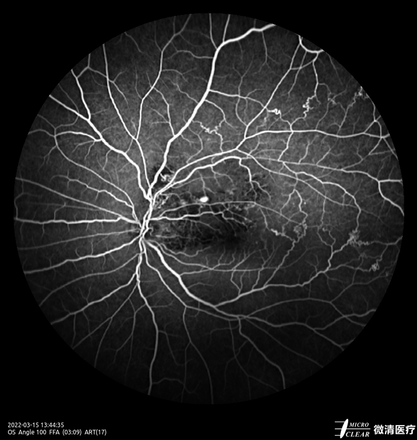 Microcleartec's tweet image. #BRVO (Branch Retinal Vein Occlusion)
Pictured by Apollo, the #ConfocalRetinalOphthalmoscope
#retinopathy #autofluorescence #fluorescenceangiography #funduscamera #retinaldiseases #Oct #laserscanning