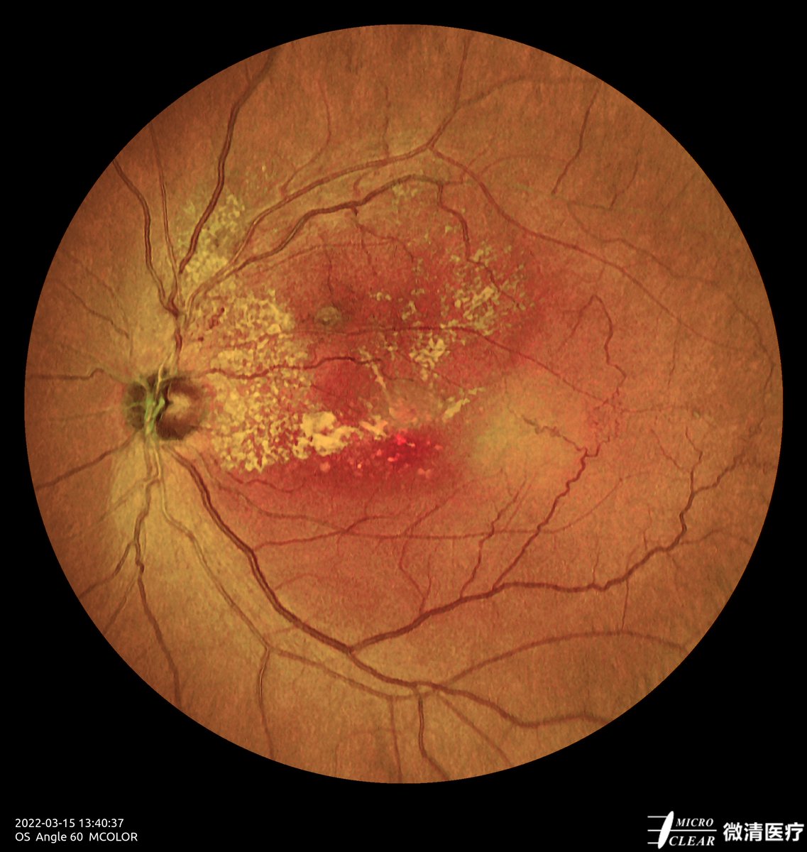 Microcleartec's tweet image. #BRVO (Branch Retinal Vein Occlusion)
Pictured by Apollo, the #ConfocalRetinalOphthalmoscope
#retinopathy #autofluorescence #fluorescenceangiography #funduscamera #retinaldiseases #Oct #laserscanning