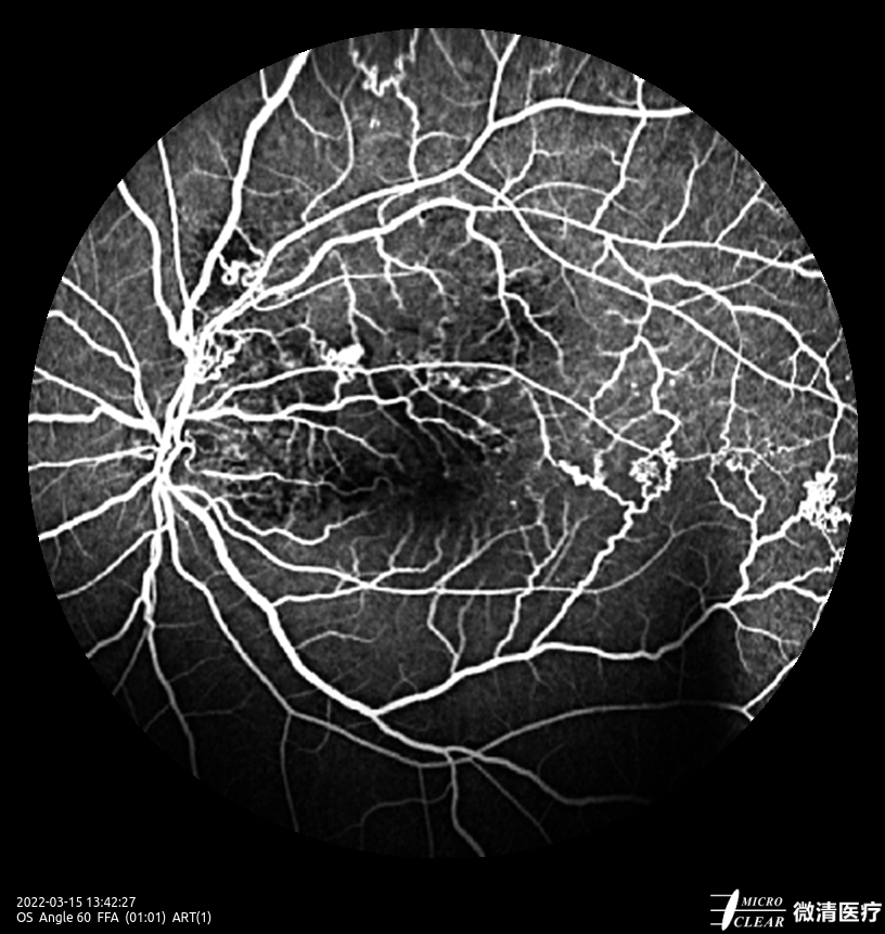#BRVO (Branch Retinal Vein Occlusion)
Pictured by Apollo, the #ConfocalRetinalOphthalmoscope
#retinopathy #autofluorescence #fluorescenceangiography #funduscamera #retinaldiseases #Oct #laserscanning