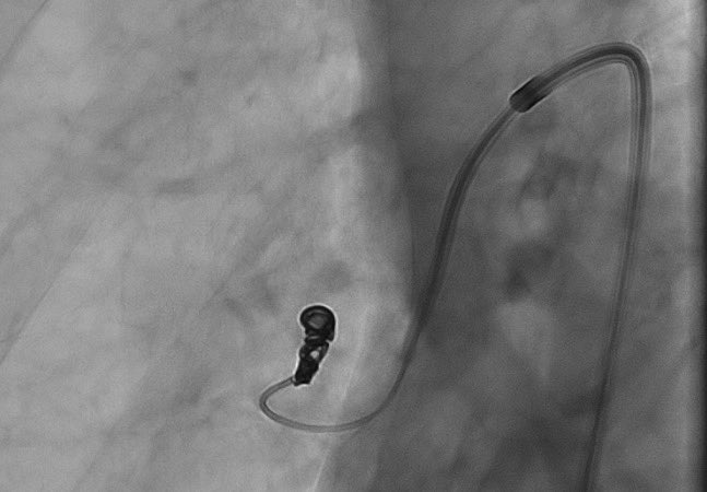 bsc_io_e's tweet photo. An exciting milestone was met this week thanks to @thefibroidlady who performed the 1st in human #EMBOLDcoils case – pt suffered from multiple pulmonary AVMs that were successfully occluded. Huge TY Dr. Caridi for your partnership along the way. #iRad https://t.co/2vYWt4xL07 https://t.co/wOWUbT0ncX