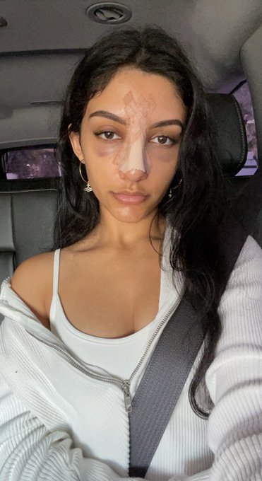 day 2 post op https://t.co/7qqQajKKFj