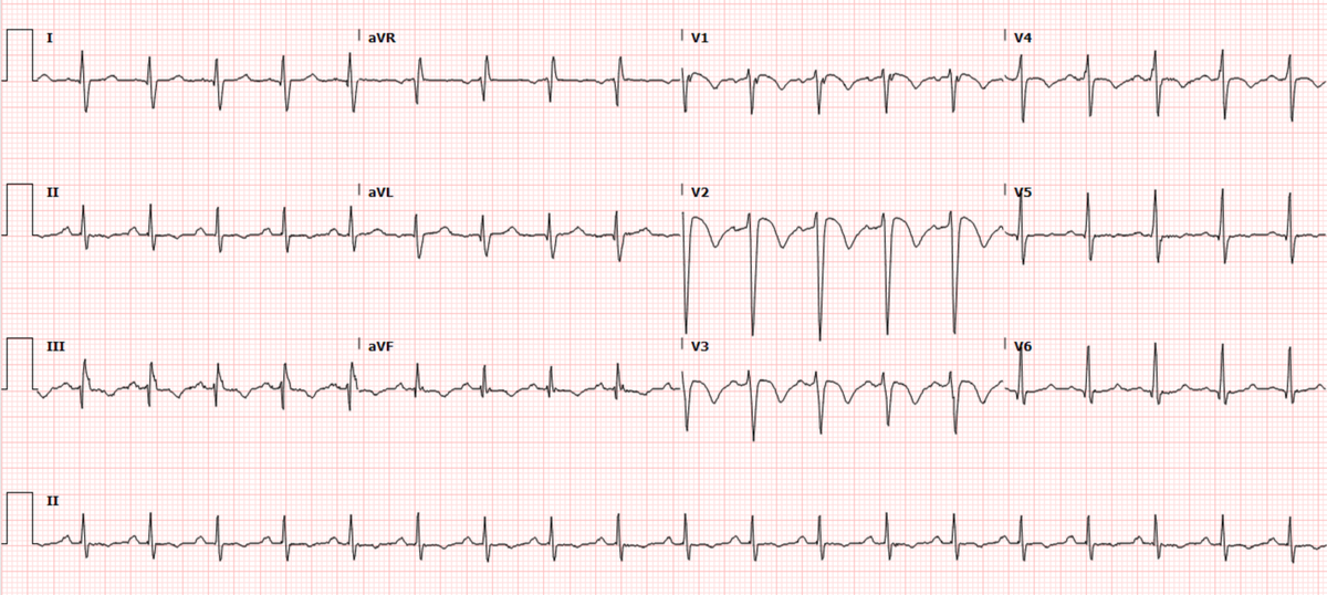 smithECGBlog's tweet photo. A man in his 40s with RUQ abdominal pain.  The ECG is nearly pathognomonic, but how do you think it was interpreted?  @PendellM 

https://t.co/3UPAEDAfQa https://t.co/GzgUxpdZcy