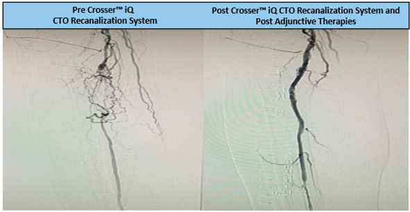 Todd_BDPI's tweet photo. #CrosseriQ catheter used in a 20cm CTO for a total SFA occlusion and observed a 1 minute 10 second activation time to cross. Great case by Dr. Cawich! #CrossThisFast
For use in peripheral artery CTOs; Not for use in carotid arteries. Safety info: https://t.co/pID8ymQhzz https://t.co/msibjMbN1A