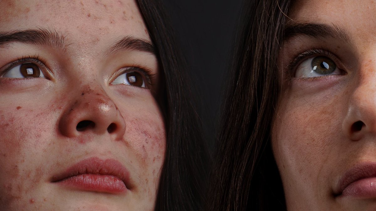 Nearly 150 million google searches for #acne every month! We are delighted to announce the launch of https://t.co/mJCWEU8wQf for the U.S. community to support parents of teens with acne in their quest for information and solutions. 
Visit https://t.co/6weAJzIrrn! https://t.co/ZsP3w2D0lO