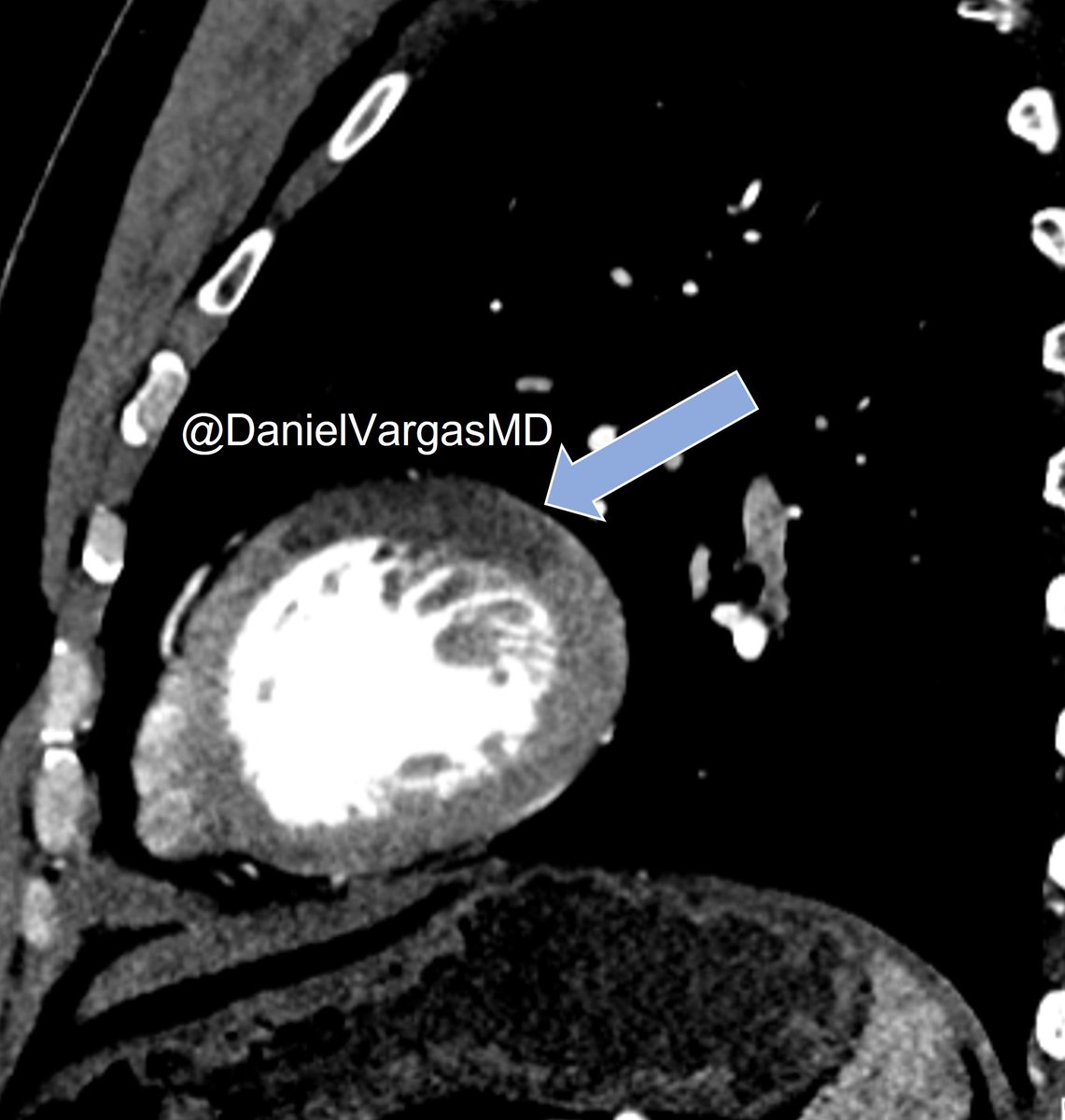 Daniel Vargas, MD (@danielvargasmd) on Twitter photo 🫀So important to learn to recognize acute MI on CT!
Often seen on dissection studies like this one... first diagonal territory. Sag hardened window to ⬆️conspicuity
<a href="/TLHM_MD/">Tan-Lucien Mohammed, MD, FACR</a> <a href="/kirschj/">Jacobo Kirsch, MD, MBA, FACR</a> <a href="/EricWillMD/">Eric Williamson</a> <a href="/DeCeccoCN/">Carlo N. De Cecco, MD, PhD</a> <a href="/LucyModahlMD/">Lucy Modahl</a> <a href="/CsFuss/">Dr. Cristina Fuss</a> <a href="/Arzanauskaite/">Dr Monika Radikė (Aržanauskaitė) also on BlueSky</a> <a href="/blanca_domenech/">Blanca Domenech-Ximenos</a> <a href="/NASCISociety/">NASCI</a> 🫀So important to learn to recognize acute MI on CT!
Often seen on dissection studies like this one... first diagonal territory. Sag hardened window to ⬆️conspicuity
<a href="/TLHM_MD/">Tan-Lucien Mohammed, MD, FACR</a> <a href="/kirschj/">Jacobo Kirsch, MD, MBA, FACR</a> <a href="/EricWillMD/">Eric Williamson</a> <a href="/DeCeccoCN/">Carlo N. De Cecco, MD, PhD</a> <a href="/LucyModahlMD/">Lucy Modahl</a> <a href="/CsFuss/">Dr. Cristina Fuss</a> <a href="/Arzanauskaite/">Dr Monika Radikė (Aržanauskaitė) also on BlueSky</a> <a href="/blanca_domenech/">Blanca Domenech-Ximenos</a> <a href="/NASCISociety/">NASCI</a>