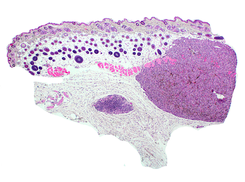 broadinstitute's tweet photo. Using #CRISPR, Broad scientists have built new models of melanoma, the deadliest skin cancer. The findings not only shed light on key mutations in melanoma, but also suggest a new way to study the role of specific genes in other cancers. https://t.co/XHEzmlztQa https://t.co/zlzNpbKRyk