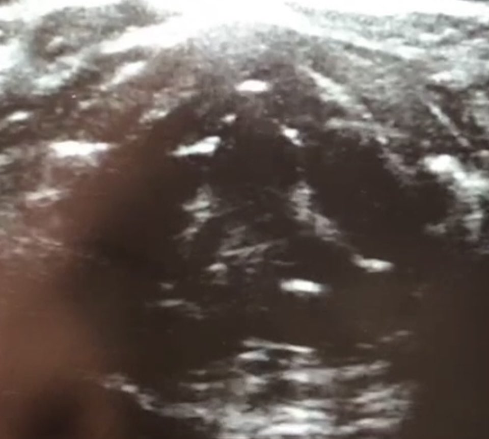 JodiAllenSLT's tweet image. Research @uclh sponsorship ✅ HRA &amp;amp; REC Approval ✅ Confirmation of Capacity &amp;amp; Capability ✅ The ducks are in a row 🐥🐥🐥 &amp;amp; our next #QueenSquareSpeechies project ready to go 🤩🤓😃