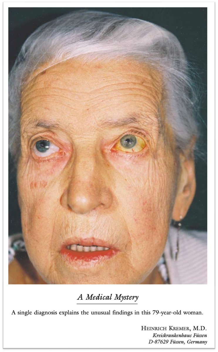 Tony Breu (@tony_breu) on Twitter photo 1/3 - The Mystery
In medical school, I was warned to "beware the patient with unilateral icterus" as this portended something bad.
As in this case from <a href="/NEJM/">NEJM</a>. 
What can explain this finding?
nejm.org/doi/pdf/10.105… 1/3 - The Mystery
In medical school, I was warned to "beware the patient with unilateral icterus" as this portended something bad.
As in this case from <a href="/NEJM/">NEJM</a>. 
What can explain this finding?
nejm.org/doi/pdf/10.105…