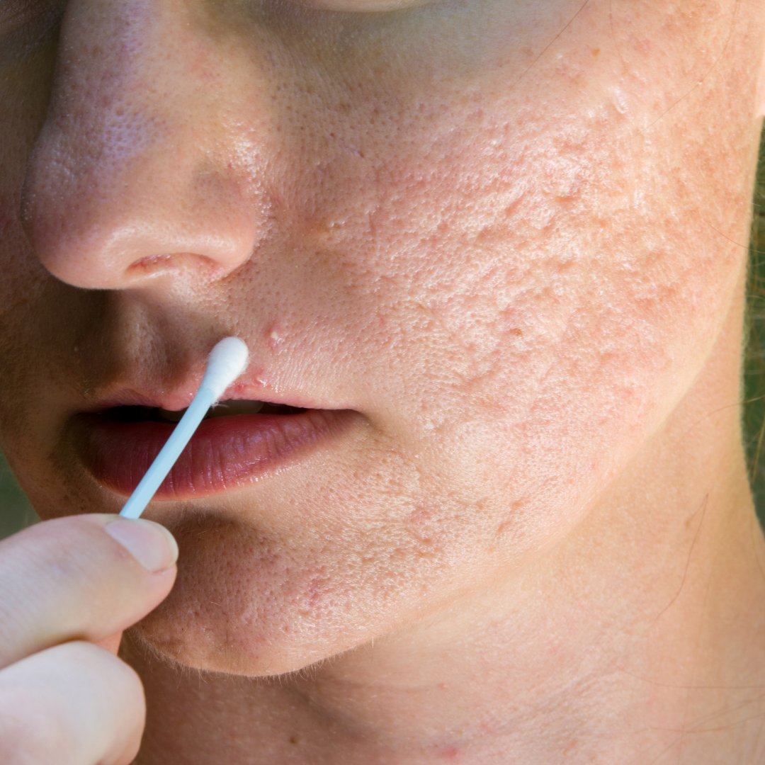 _forcesofnature's tweet photo. Cystic Acne is caused by bacteria getting into the pores which, in turn, causes swelling and inflammation resulting in painful, pus-filled pimples that formed deep into the skin. So, how can you treat it? https://t.co/Kwl3X4E95Z https://t.co/UHsdToOR0g