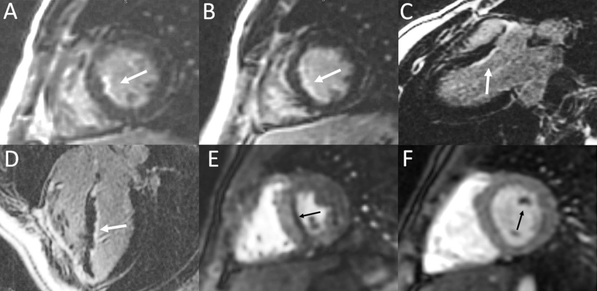 CircImaging's tweet photo. Unique #PedsCards report of MI in a teen after COVID‐19 related MIS‐C with recovered systolic function from @UTHSCPedsCards demonstrating #whyCMR value in #circimage @AnthonyMerlocco @GarySBeasley #AHAJournals https://t.co/OeJtAkNeOd https://t.co/YTNCMPFDlF