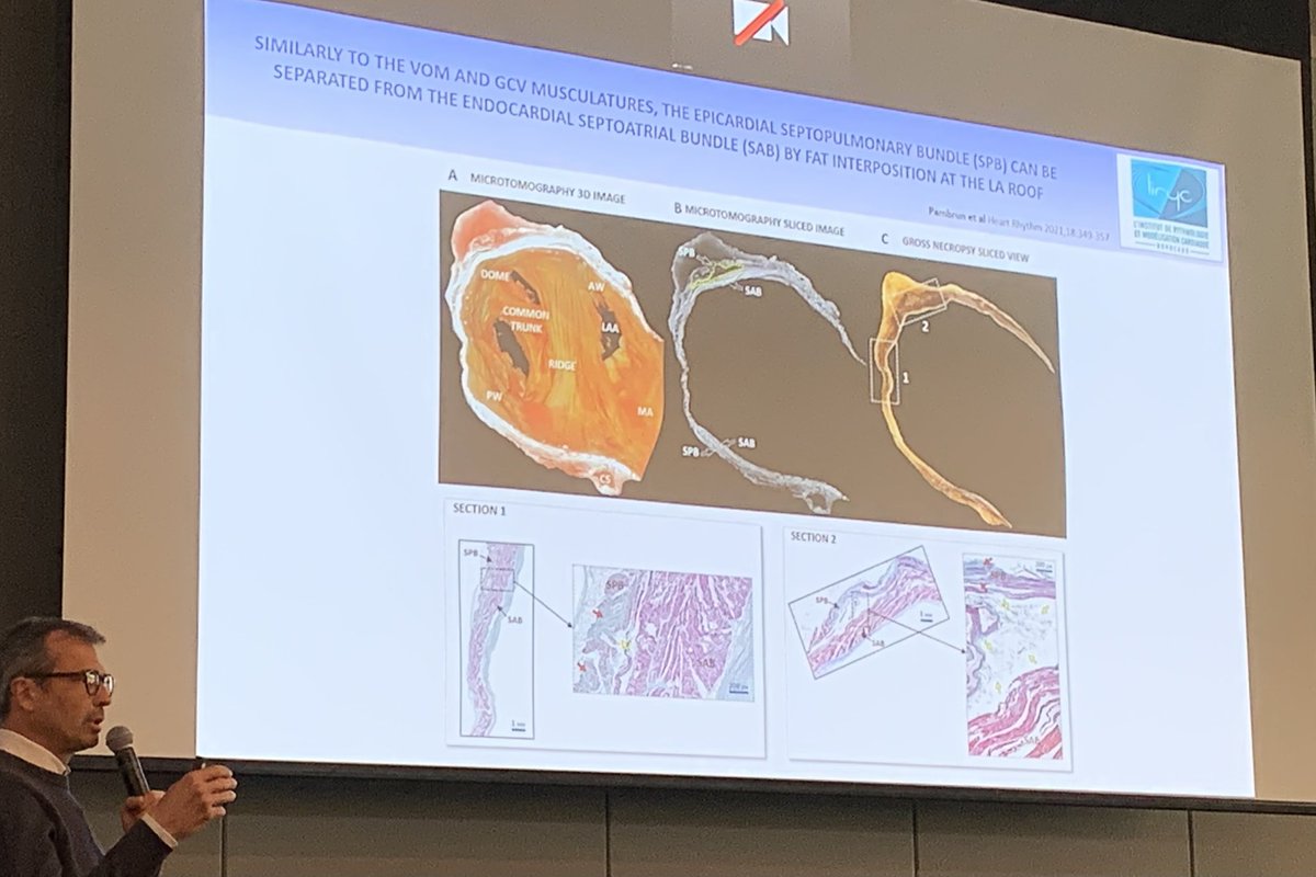 netta_doc's tweet photo. Pierre Jais on importance of #VeinofMarshall isolation for both acute success & durable block, and septopulmonary bundle separated by fat -> difficulty with success in #AblateAFib
#EPBiodesign22 https://t.co/9ZmGrWUhZX