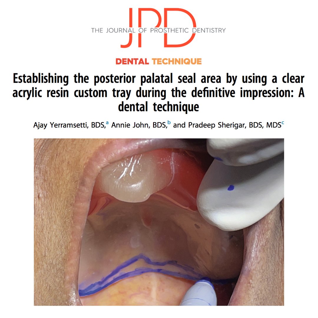 JPDentistry's tweet photo. The posterior palatal seal improves retention and fit of a maxillary #completedenture. This article describes a #dentaltechnique on how to record this region with #dentureimpressions. 

Learn more: https://t.co/QgVeyvkHvL https://t.co/GIzEcnALFx