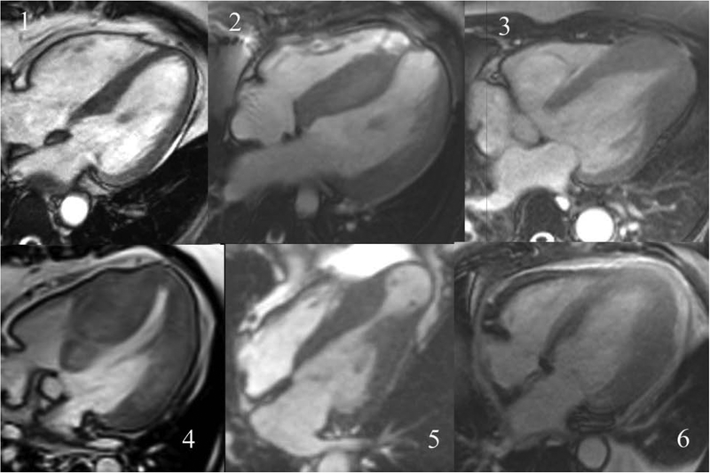 From HCMR, the 6 subtypes of HCM as identified by CMR #CardsJC <a href="/CardioNerds/">CardioNerds</a>