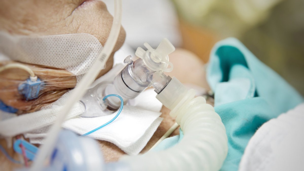 ClinicalXGA's tweet image. When Is a Tracheostomy Considered?

A tracheostomy may be performed when there are:

- Obstruction of the mouth or throat

- Breathing difficulty caused by edema (swelling), injury (lung) conditions

Source: my.clevelandclinic.org/health/treatme…

#Tracheostomy #ClinicalXperts