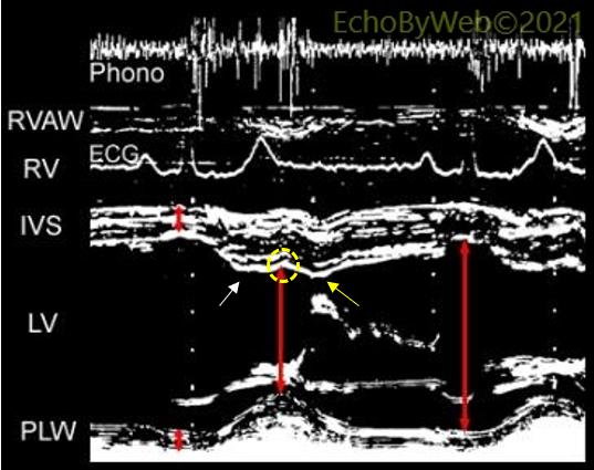 echobyweb's tweet image. Vintage echocardiography, left ventricular M-mode. In: echobyweb.com/?page_id=638&amp;amp;p…
#CardioTwitter #cvImaging #cvEcho #echofirst #cardiology #methodology #M-mode #systole