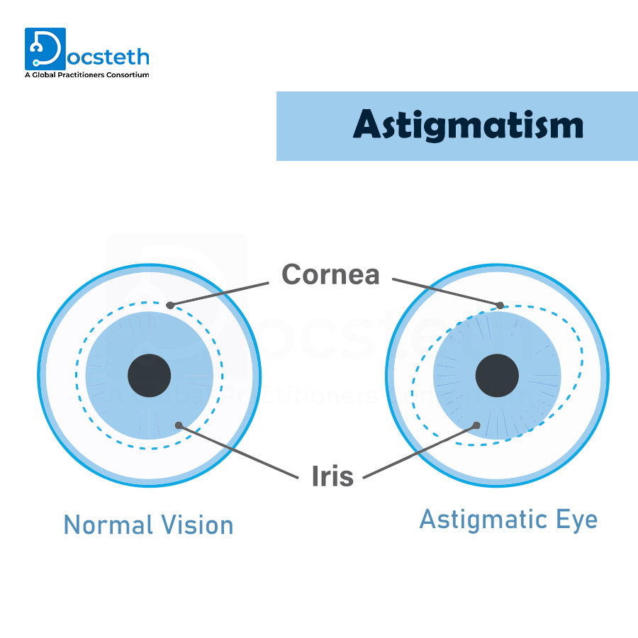 Docsteth1's tweet photo. Astigmatism is a refractive error characterised by a variation in the dioptric power of the eye from one meridian to another
*
*
For more information click on the below link
https://t.co/cDypqNK5Al
*
*
#cornea #normalvision #astigmatism #iris #docsteth #clinicpost #diseasepost https://t.co/DnoZTVk6A0