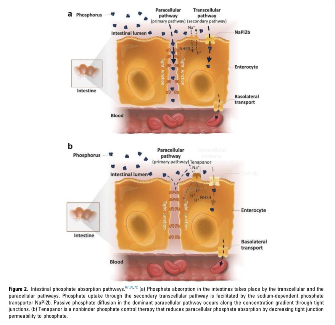 JonathanNefro's tweet photo. El intestino absorbe fosfato por 2 vías, la transcelular, saturable con concentraciones de 6mg/dL y la vía paracelular (esta no se satura)

Nuestra dieta ofrece ~80mg/dL de fosfato al lumen intestinal, por eso, la vía paracelular absorbe >80%

KIR 2022
 https://t.co/YeO4QYihep https://t.co/UkFNBbRITM