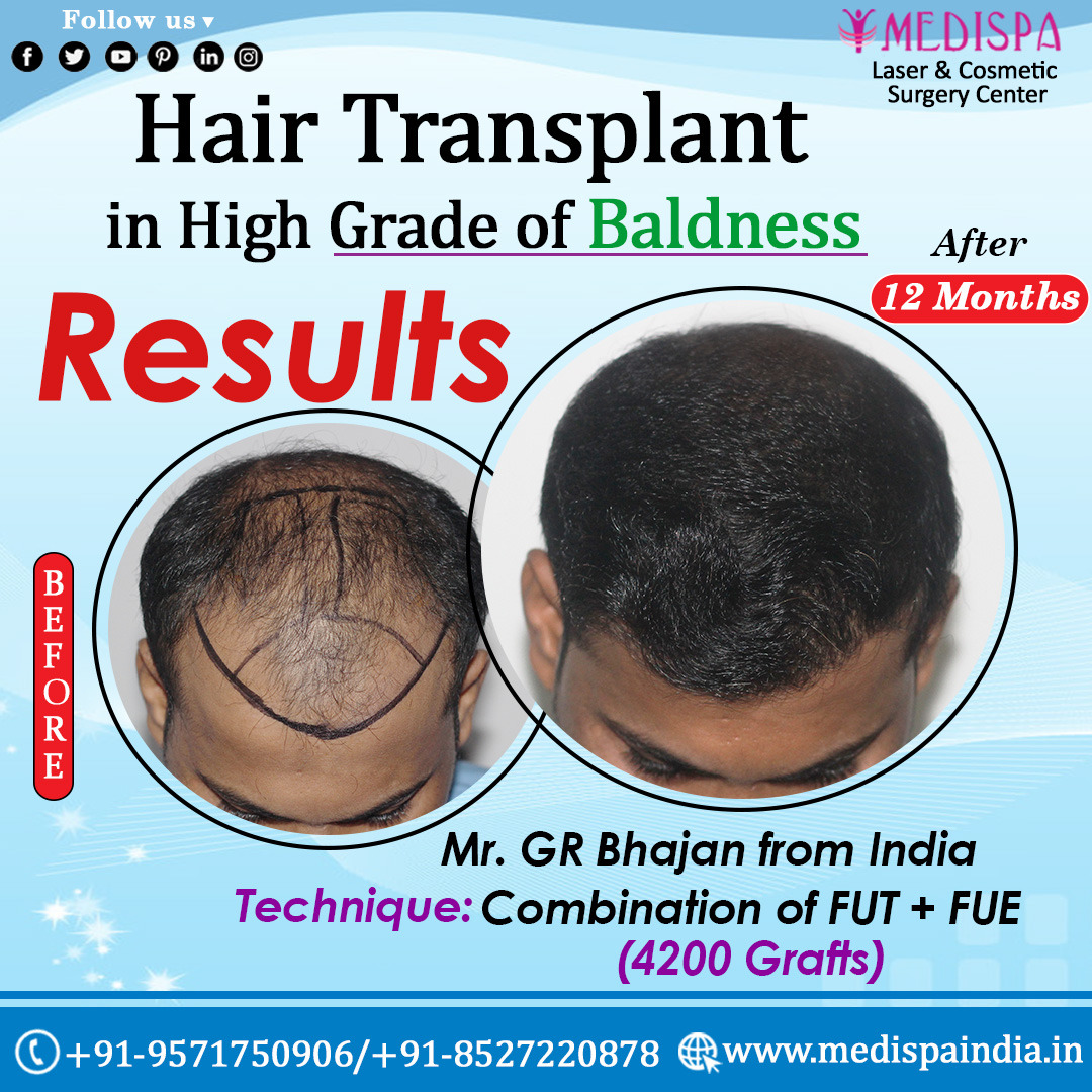 MedispaHairTransplantCenter on Twitter: MedispaHairTransplantCenter on Twitter: