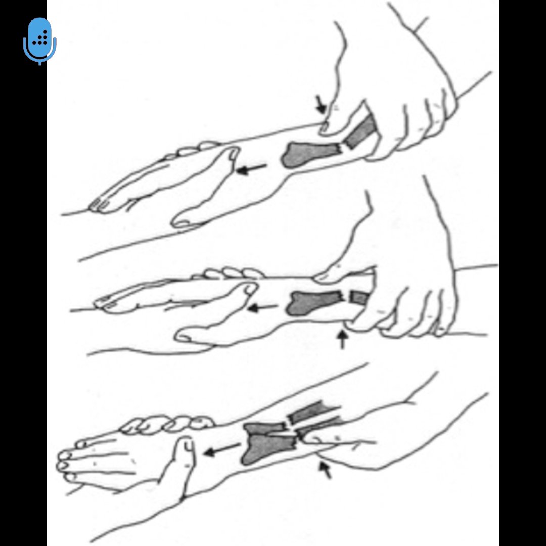 Most pediatric forearm fractures can be treated non-op with closed reduction &amp; cast immobilization. Studies show short arm casts for distal both bone forearm fractures are as effective as long arm casts. 

Learn more on our podcast. #orthotwitter orthobullets.tiny.us/4azfe8pf